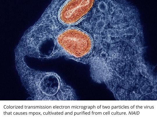 Mpox-NIH-Study-540x405-v1.jpg?